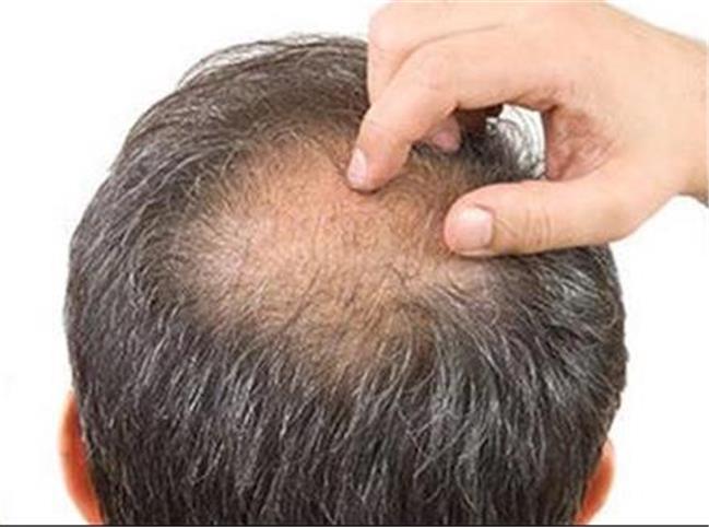 علت ریزش مو پس از کرونا چیست؟