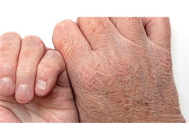 درمان خانگی خشکی پوست چیست؟