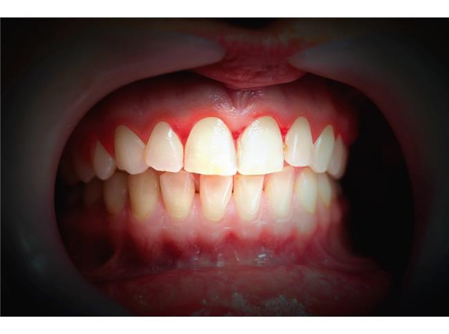 دلایل دندان قروچه و نحوه درمان آن