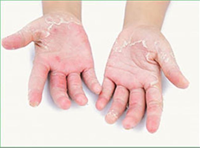 مهمترین دلیل پوست پوست شدن دستها در فصل سرد سال