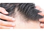 راه‌های پیشگیری از ریزش مو در مردان