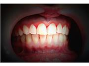 دلایل دندان قروچه و نحوه درمان آن