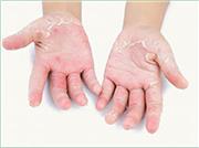 مهمترین دلیل پوست پوست شدن دستها در فصل سرد سال