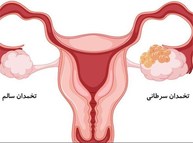 علائم سرطان تخمدان