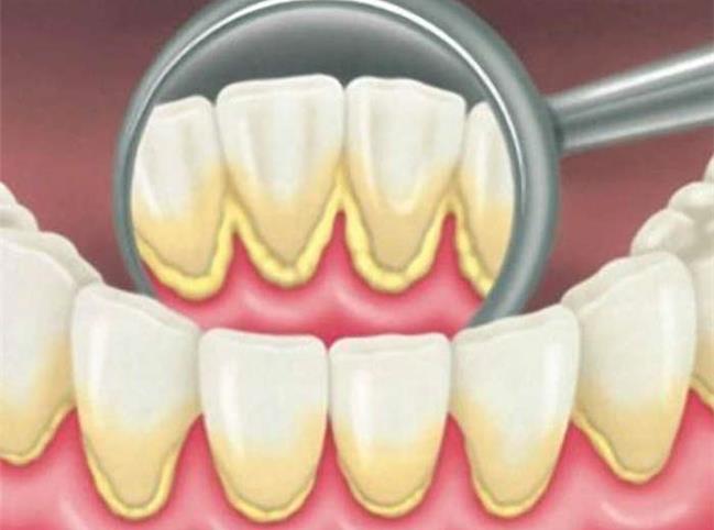 روش‌های خانگی برای از بین بردن جرم دندان