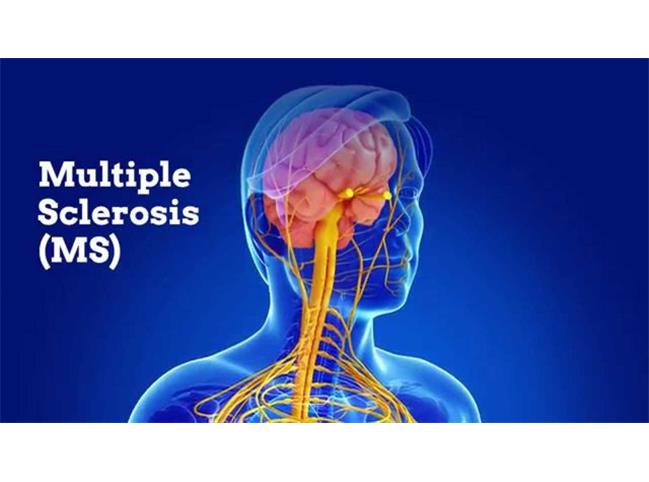 ابتلا به ام اس در چه سنی بیشتر است