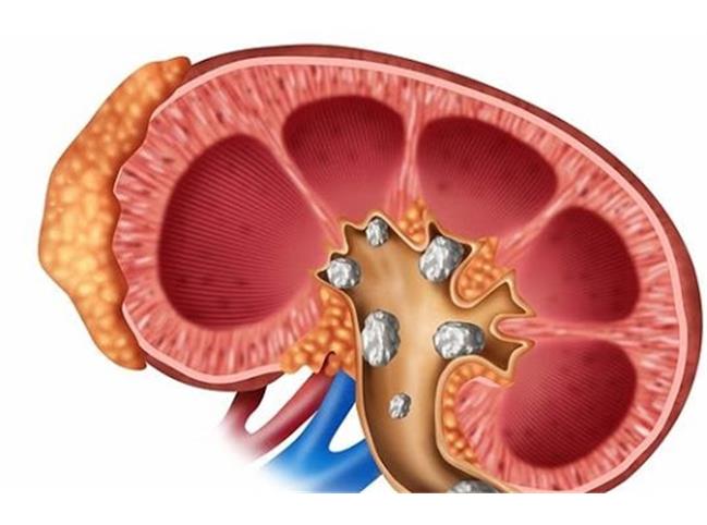 درمان سنگ کلیه در طب سنتی چگونه است
